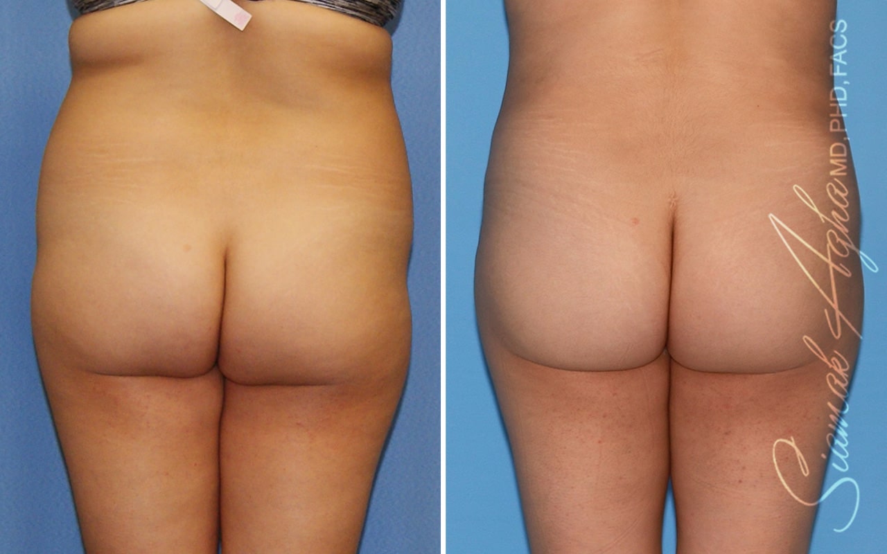 orange county brazilian butt lift patient 53 back Newport Beach, CA