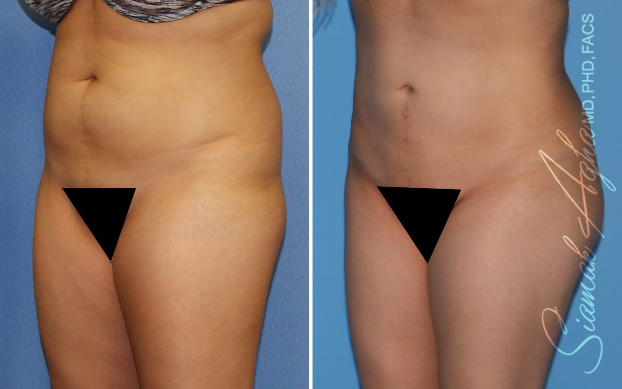 Orange County Brazilian Butt Lift Patient 53 Front Left Newport Beach, CA