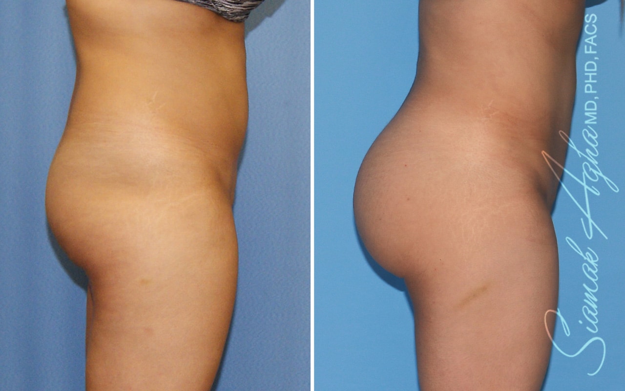 orange county brazilian butt lift patient 53 right Newport Beach, CA