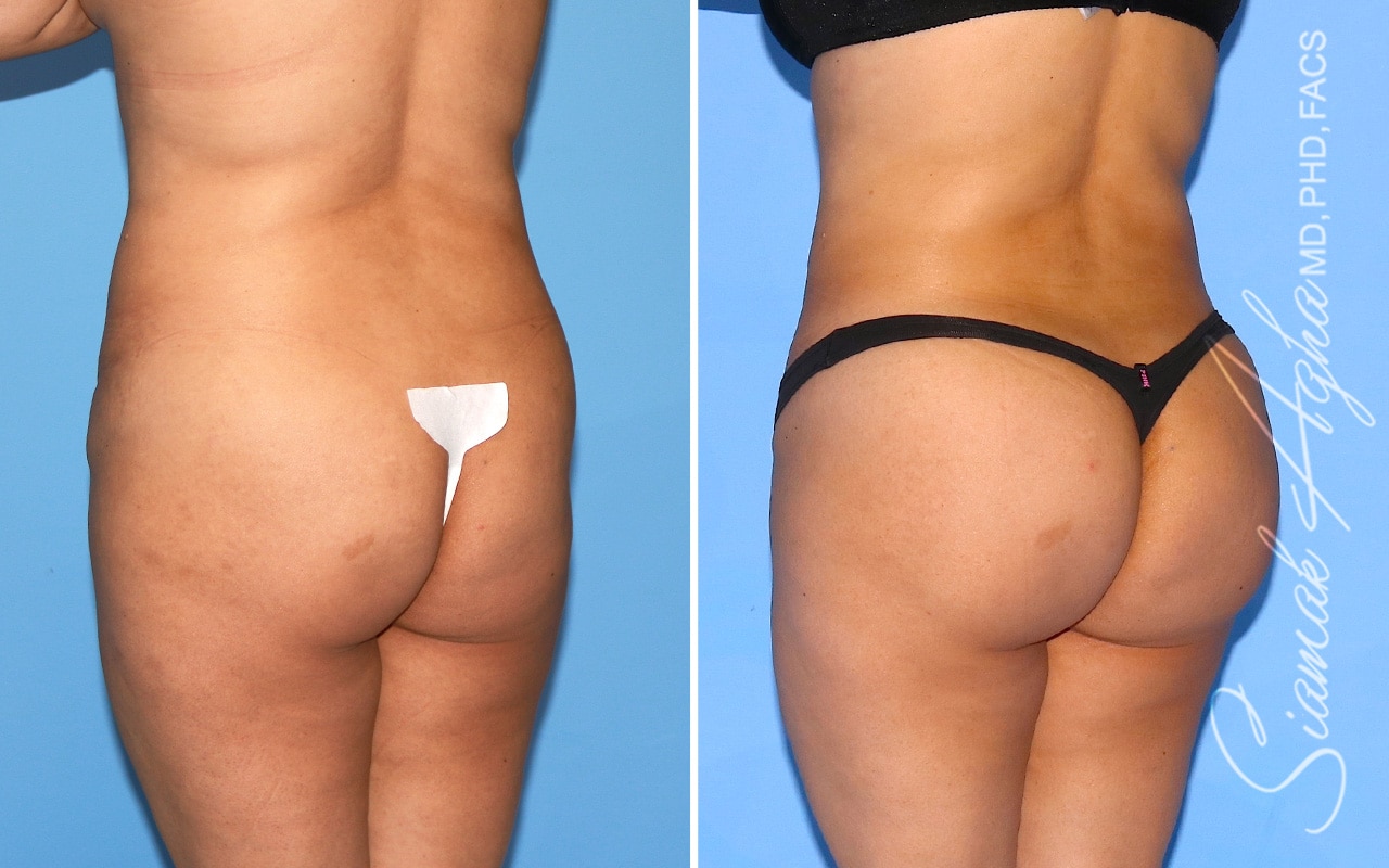 orange county brazilian butt lift patient 54 back left Newport Beach, CA