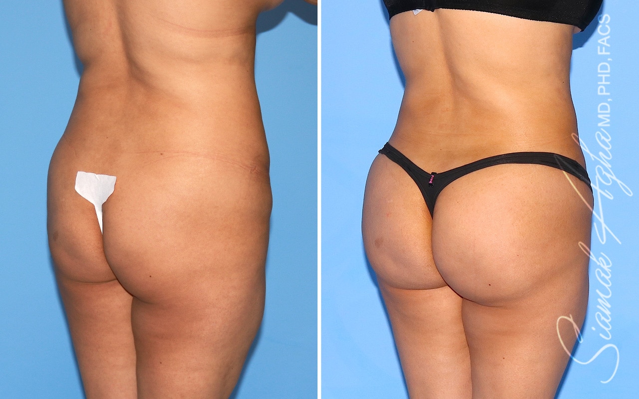 orange county brazilian butt lift patient 54 back right Newport Beach, CA