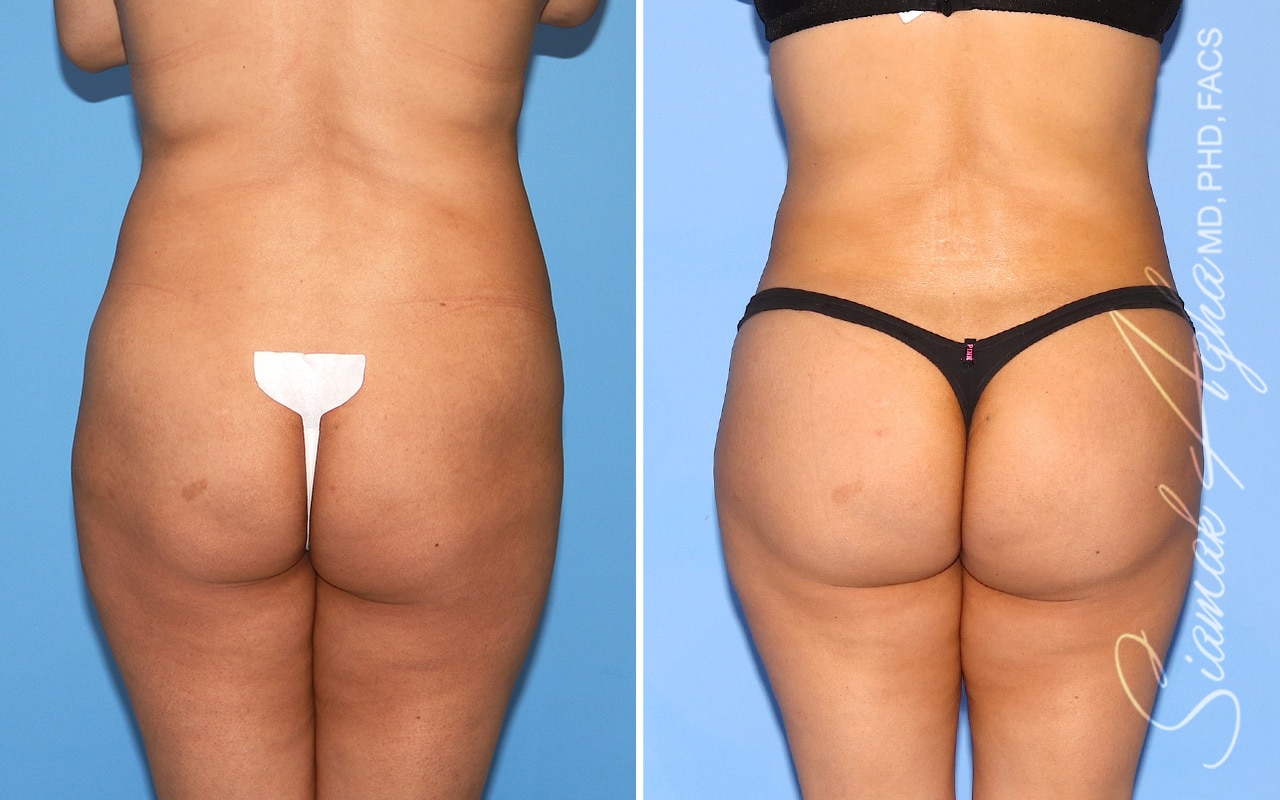 orange county brazilian butt lift patient 54 back Newport Beach, CA