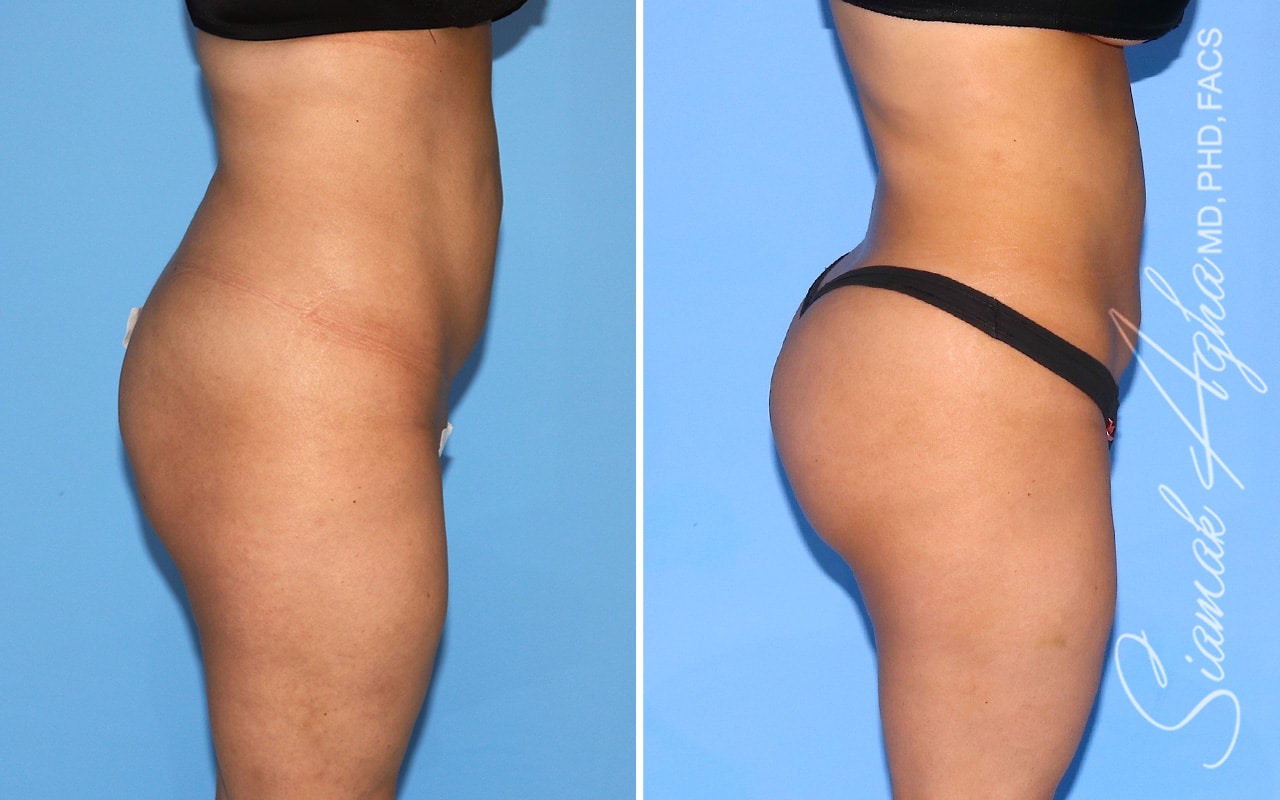 orange county brazilian butt lift patient 54 right Newport Beach, CA