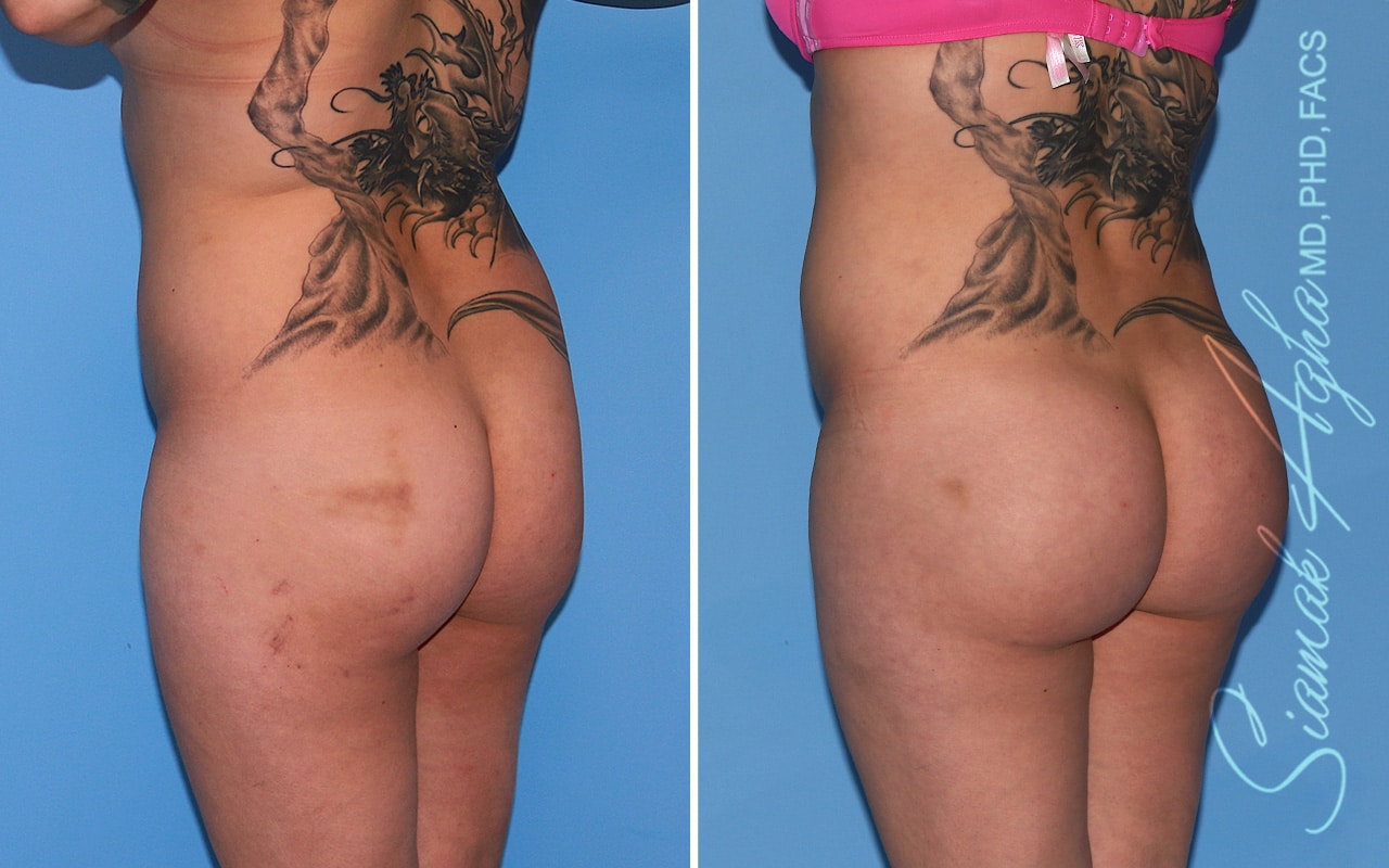 Orange County Brazilian Butt Lift Patient 55 Back Left Newport Beach, CA