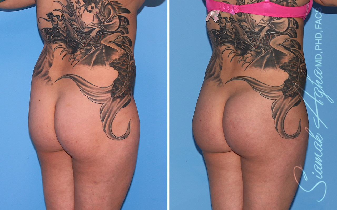 Orange County Brazilian Butt Lift Patient 55 Back Right Newport Beach, CA