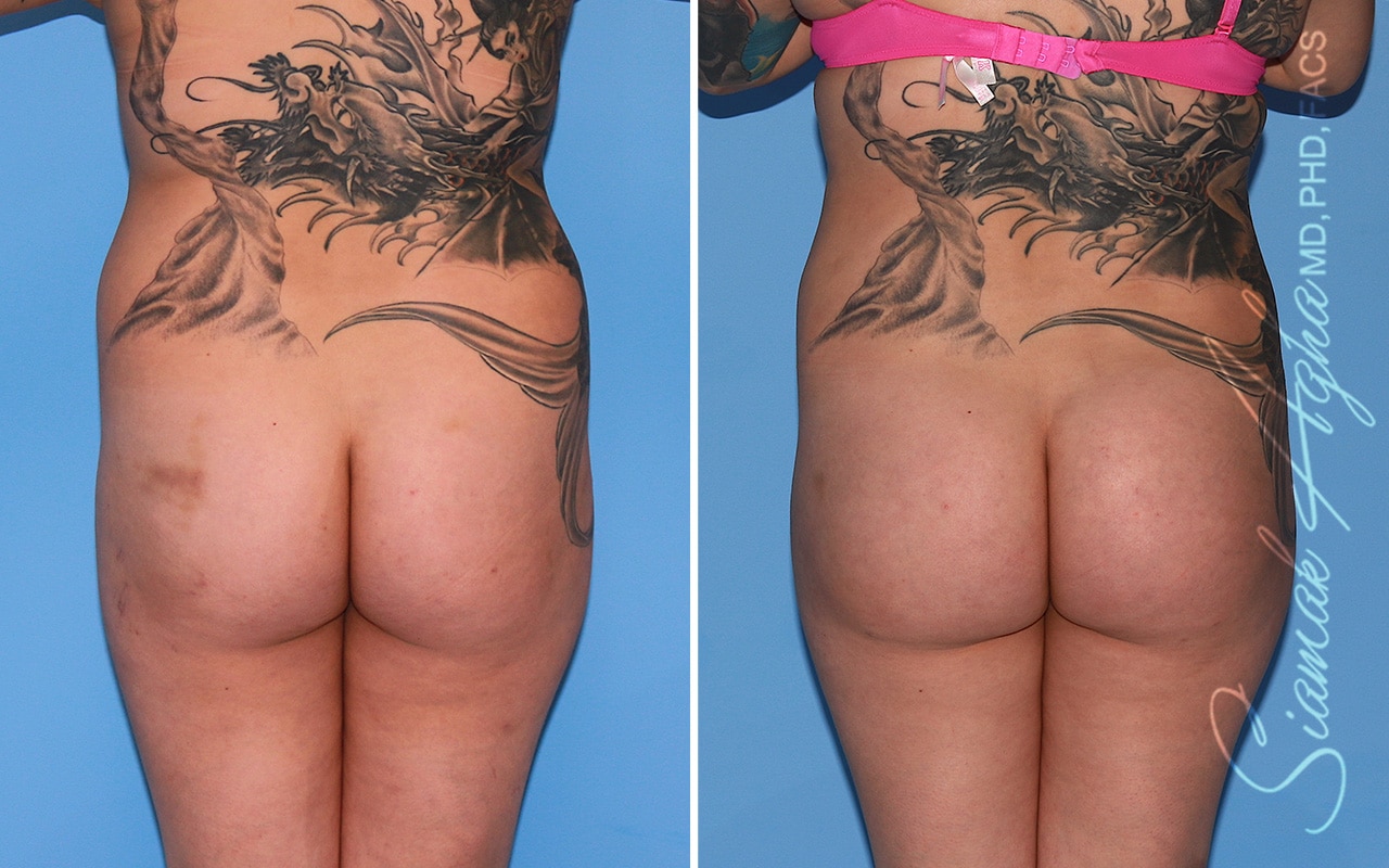 Orange County Brazilian Butt Lift Patient 55 Back Newport Beach, CA