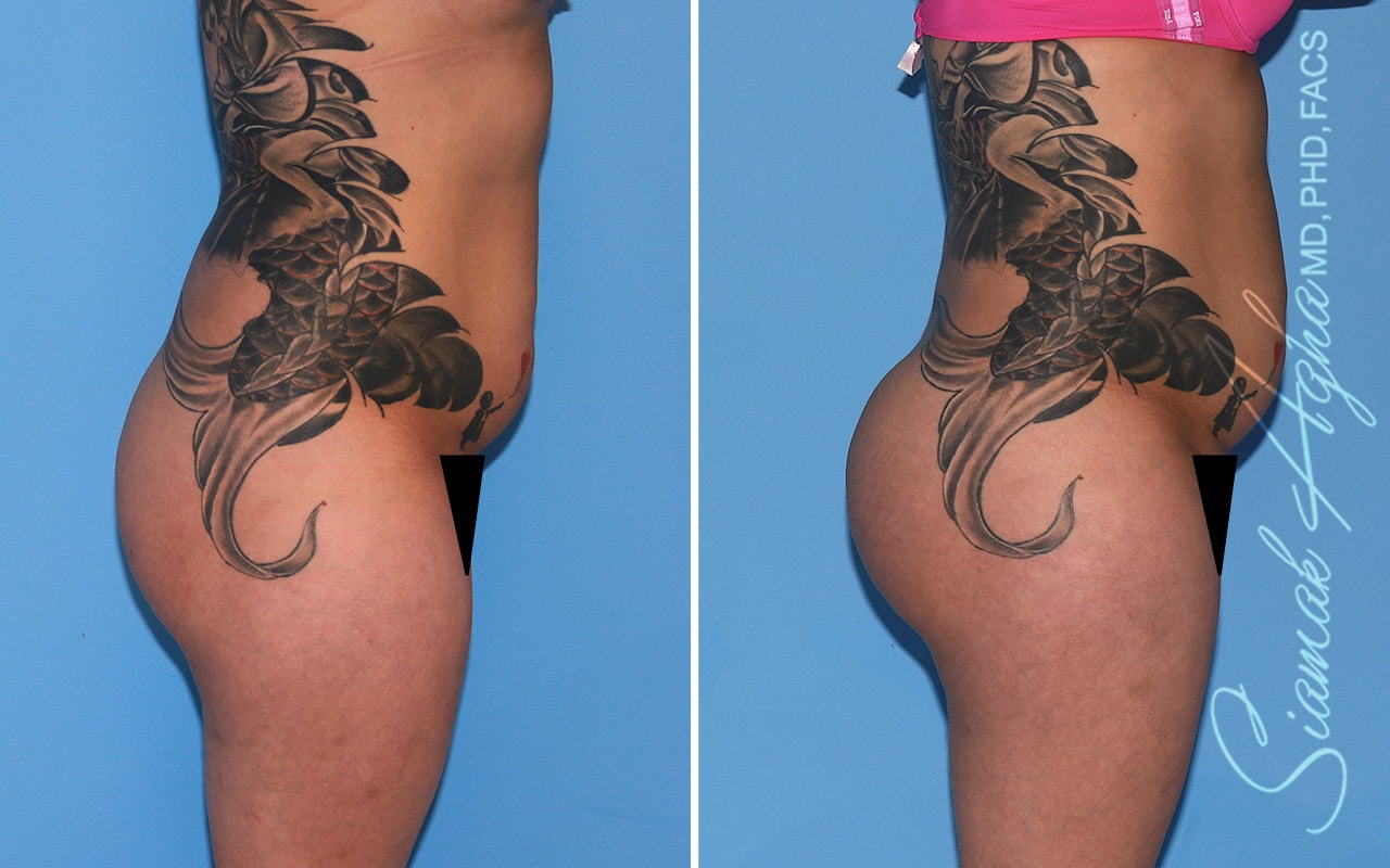 orange county brazilian butt lift patient 55 right Newport Beach, CA