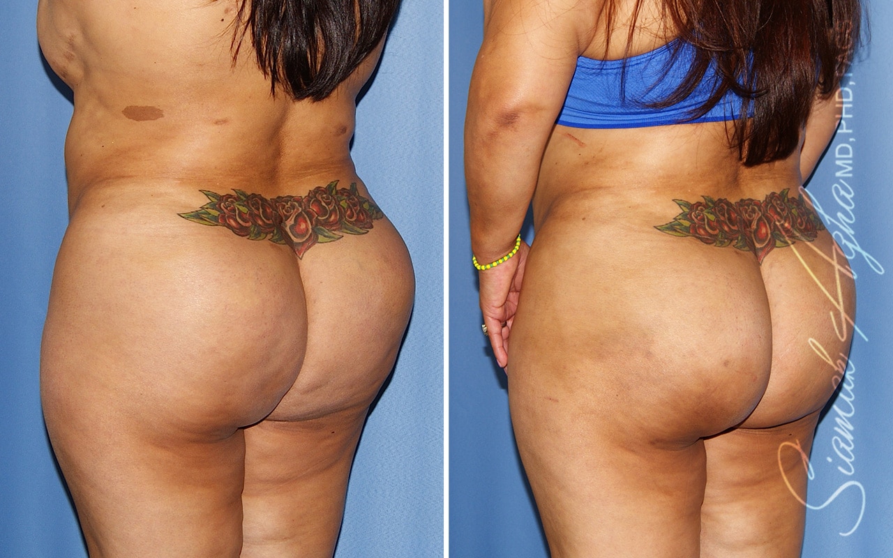 orange county brazilian butt lift patient 56 back left Newport Beach, CA