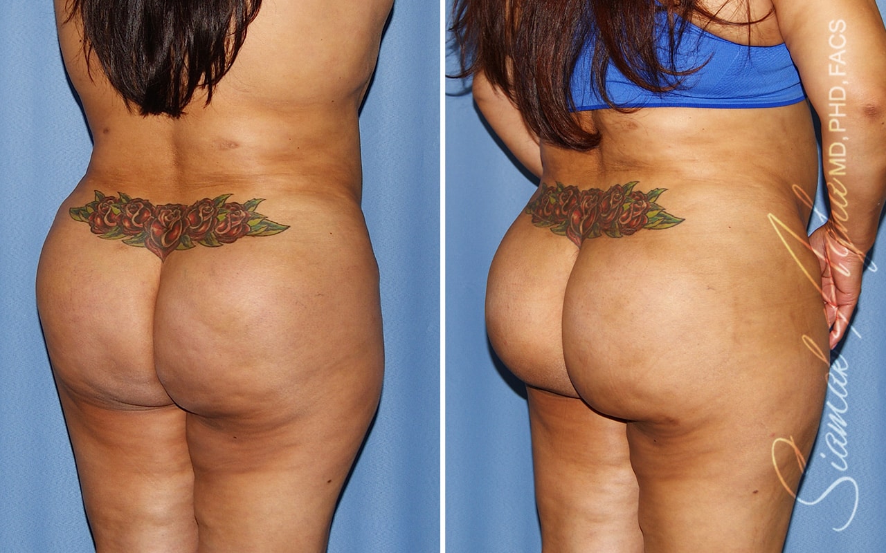 orange county brazilian butt lift patient 56 back right Newport Beach, CA