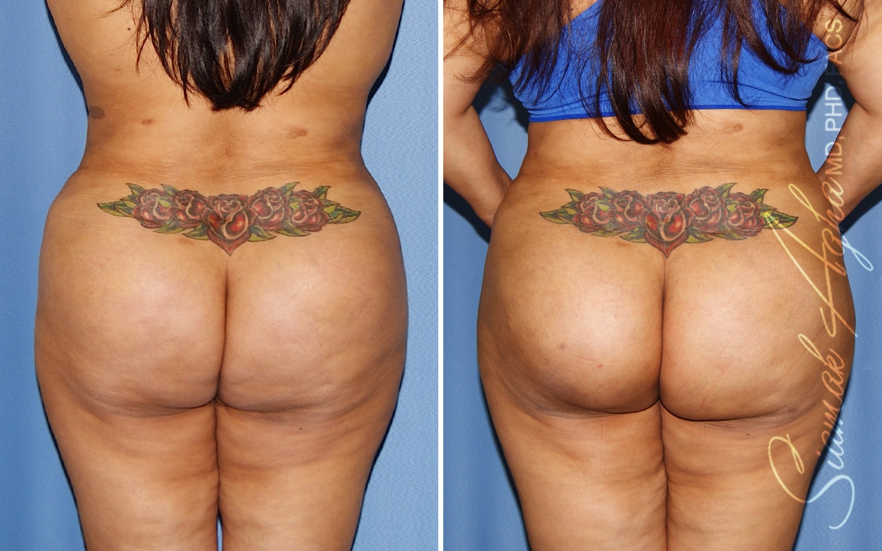 orange county brazilian butt lift patient 56 back Newport Beach, CA