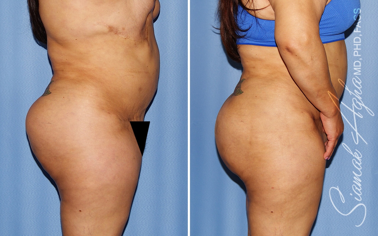 orange county brazilian butt lift patient 56 right Newport Beach, CA