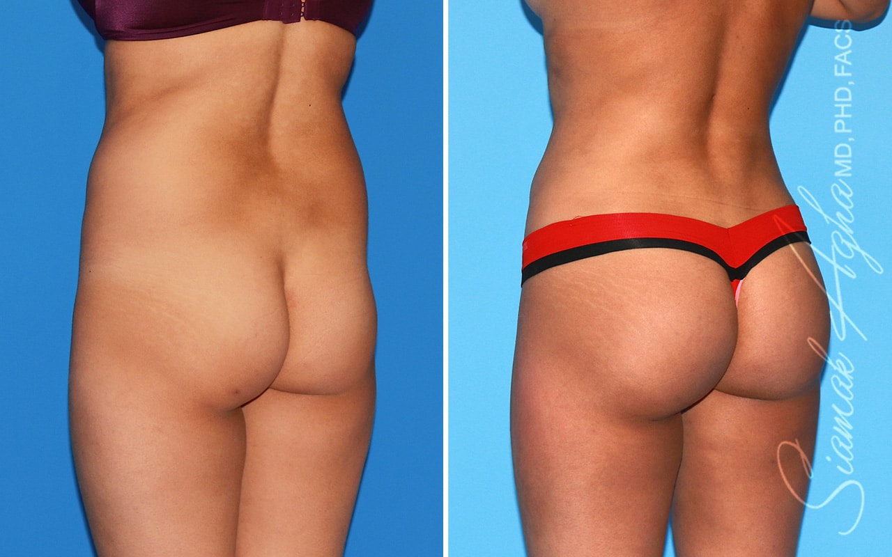 Orange County Brazilian Butt Lift Patient 57 Back Left Newport Beach, CA