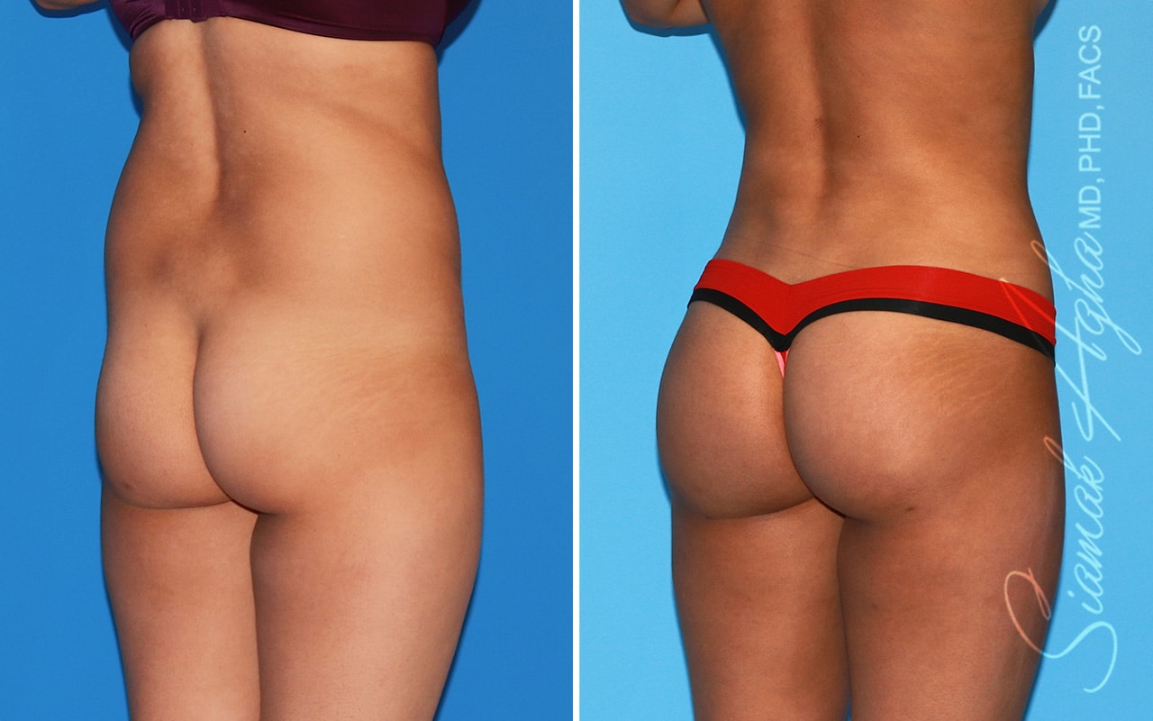 Orange County Brazilian Butt Lift Patient 57 Back Right Newport Beach, CA