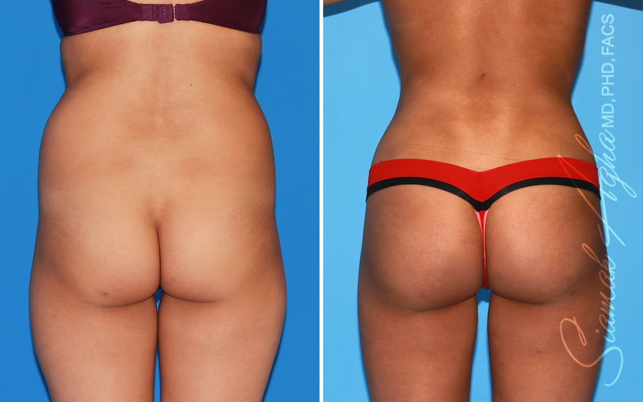 orange county brazilian butt lift patient 57 back Newport Beach, CA