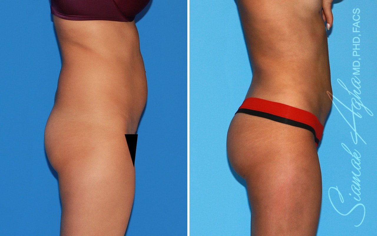 orange county brazilian butt lift patient 57 right Newport Beach, CA