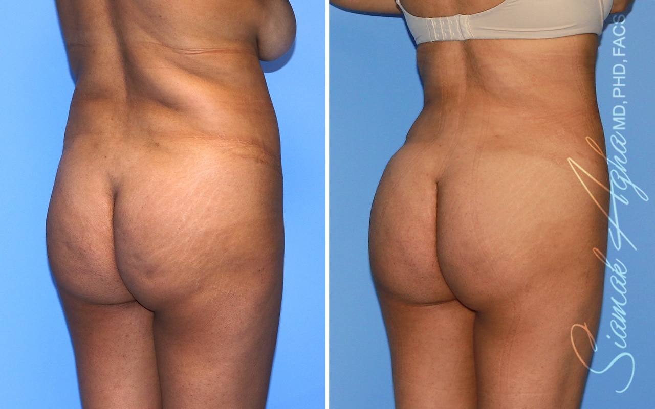 orange county brazilian butt lift patient 58 back front Newport Beach, CA