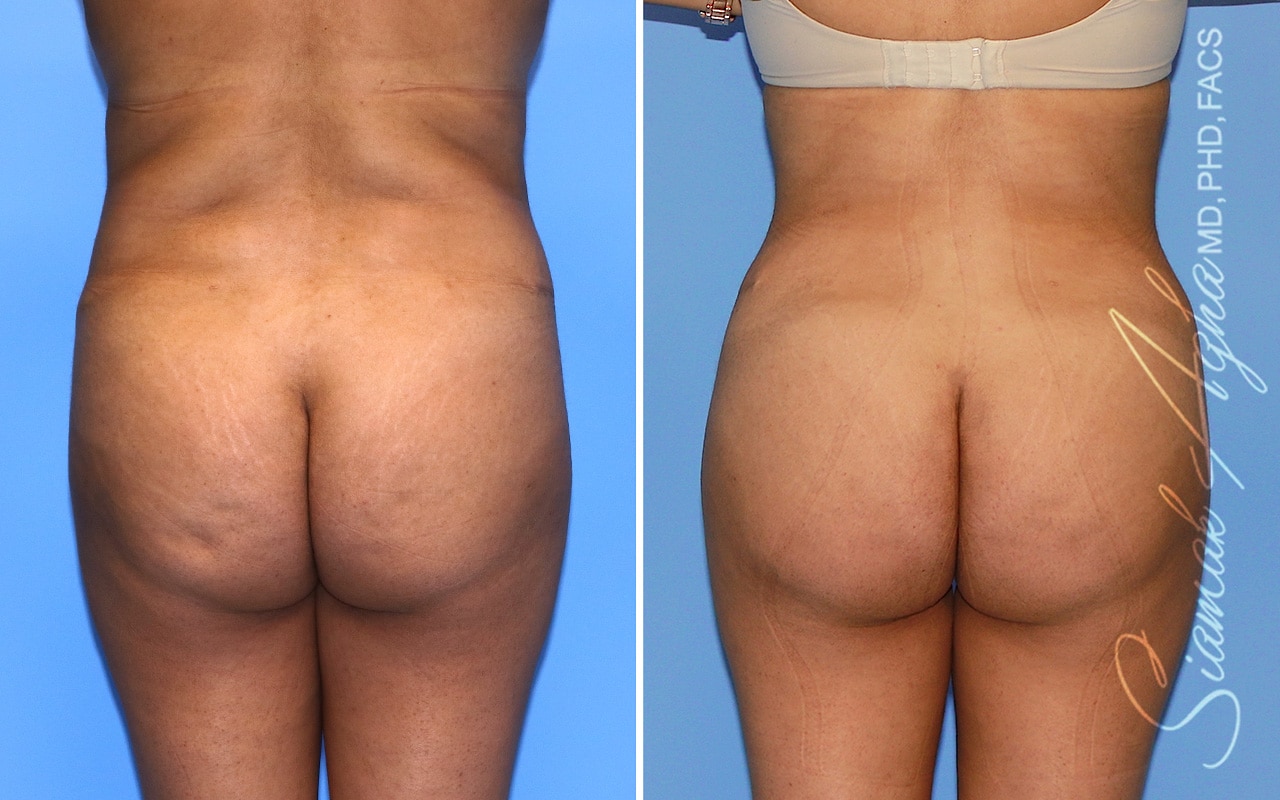 orange county brazilian butt lift patient 58 back Newport Beach, CA