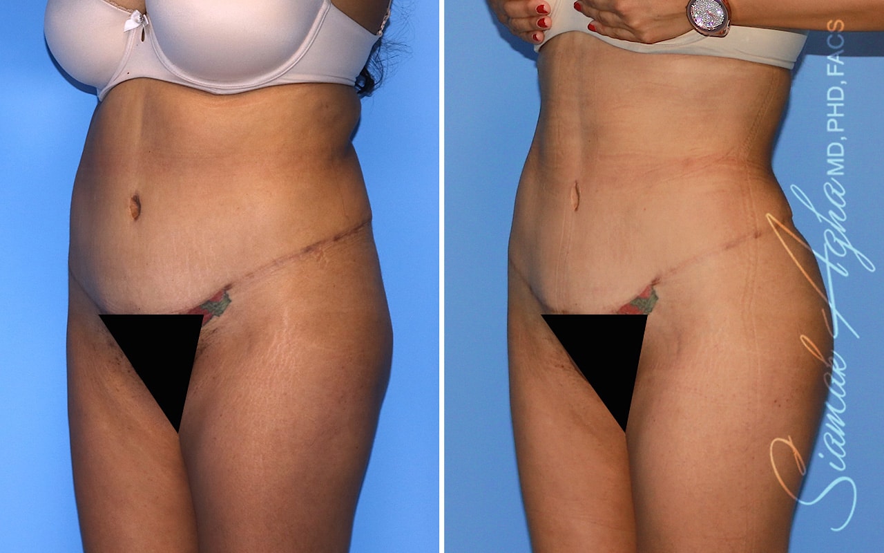 orange county brazilian butt lift patient 58 front left Newport Beach, CA