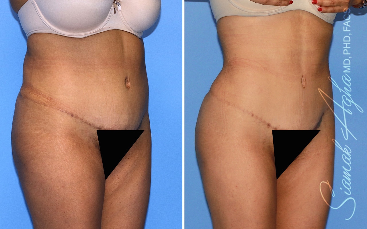 orange county brazilian butt lift patient 58 front right Newport Beach, CA