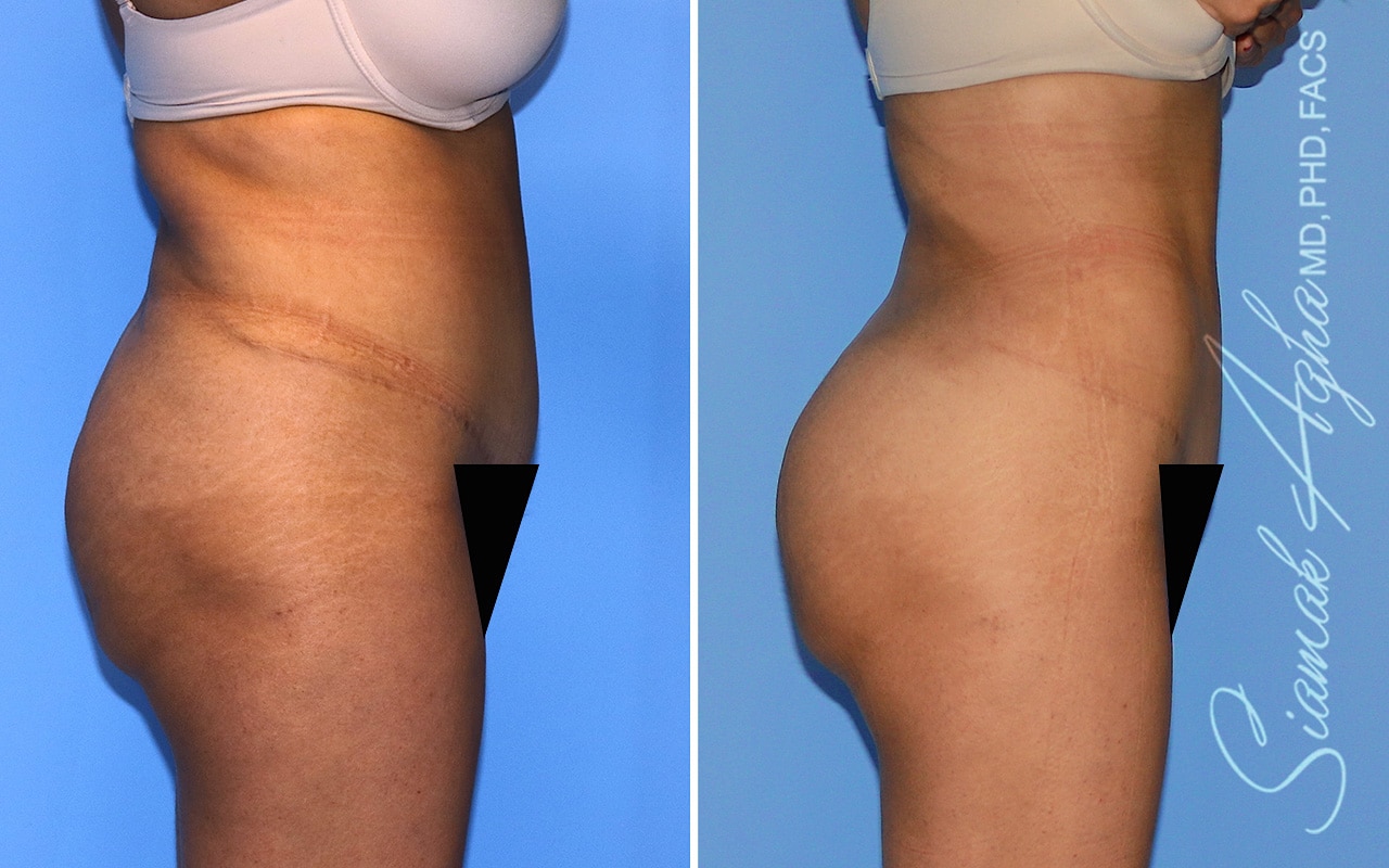 Orange County Brazilian Butt Lift Patient 58 Right Newport Beach, CA