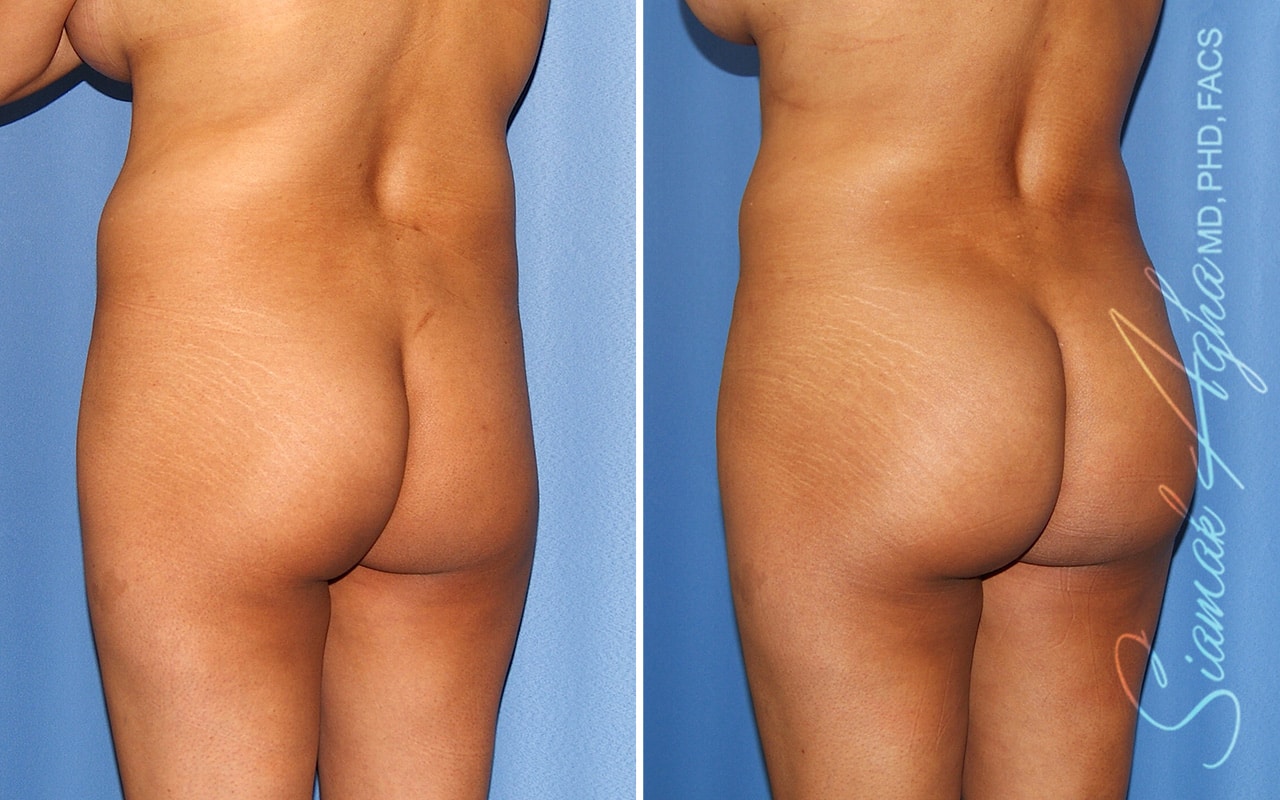 orange county brazilian butt lift patient 59 back left Newport Beach, CA