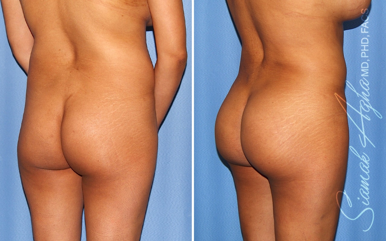 orange county brazilian butt lift patient 59 back right Newport Beach, CA