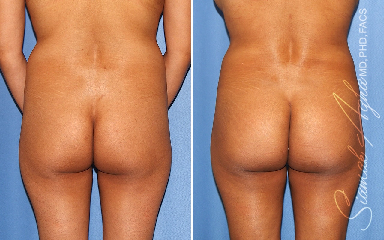 orange county brazilian butt lift patient 59 back Newport Beach, CA