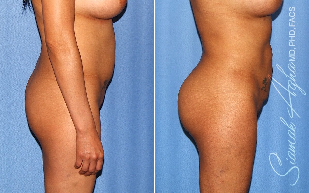 orange county brazilian butt lift patient 59 right Newport Beach, CA