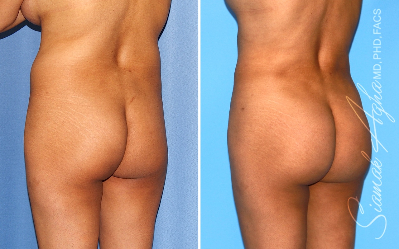 orange county brazilian butt lift patient 59b back left Newport Beach, CA