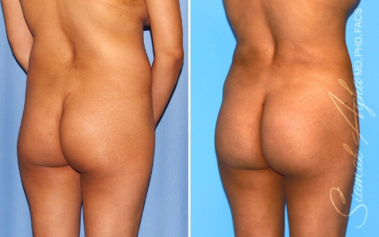 orange county brazilian butt lift patient 59b back right Newport Beach, CA