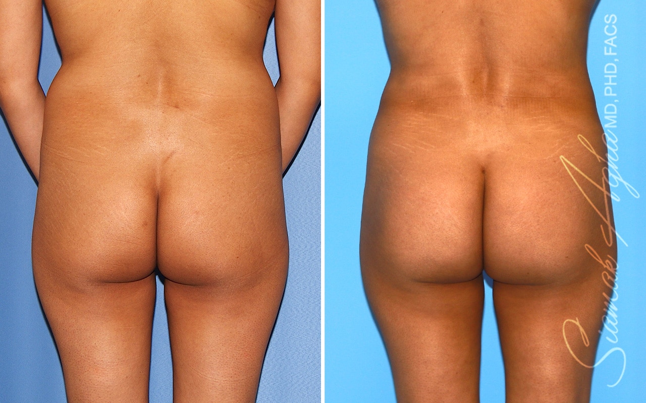 orange county brazilian butt lift patient 59b back Newport Beach, CA