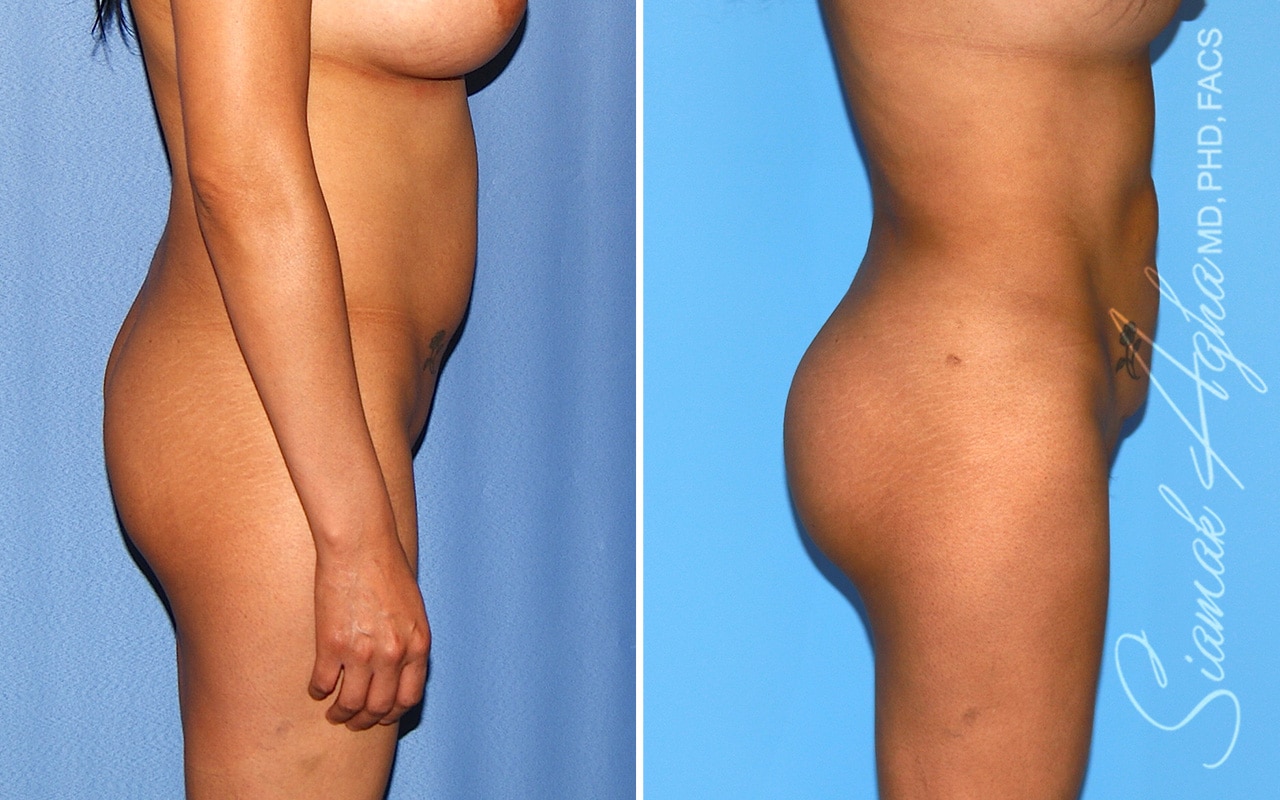 orange county brazilian butt lift patient 59b right Newport Beach, CA