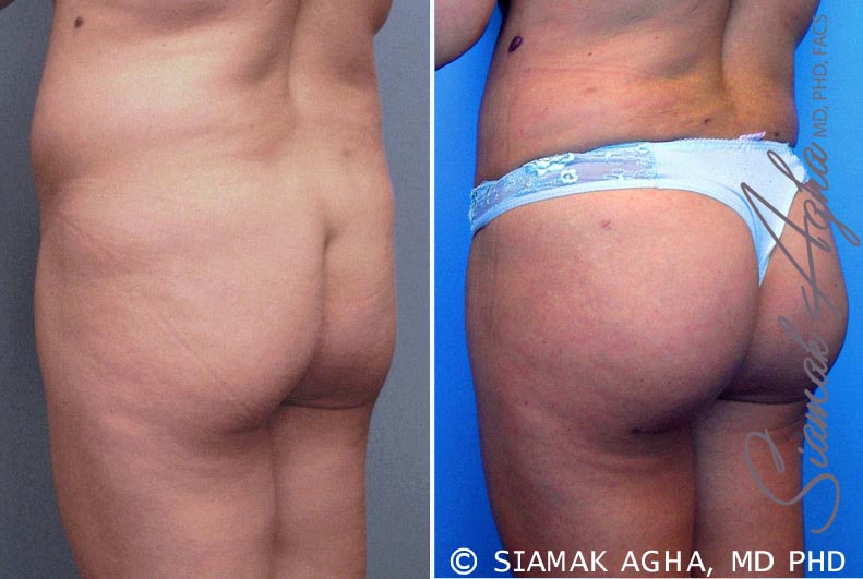 orange county brazilian butt lift patient 6 back left Newport Beach, CA