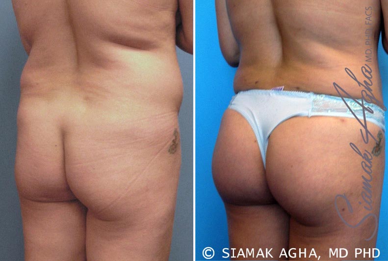 orange county brazilian butt lift patient 6 back right Newport Beach, CA