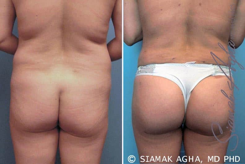 orange county brazilian butt lift patient 6 back Newport Beach, CA