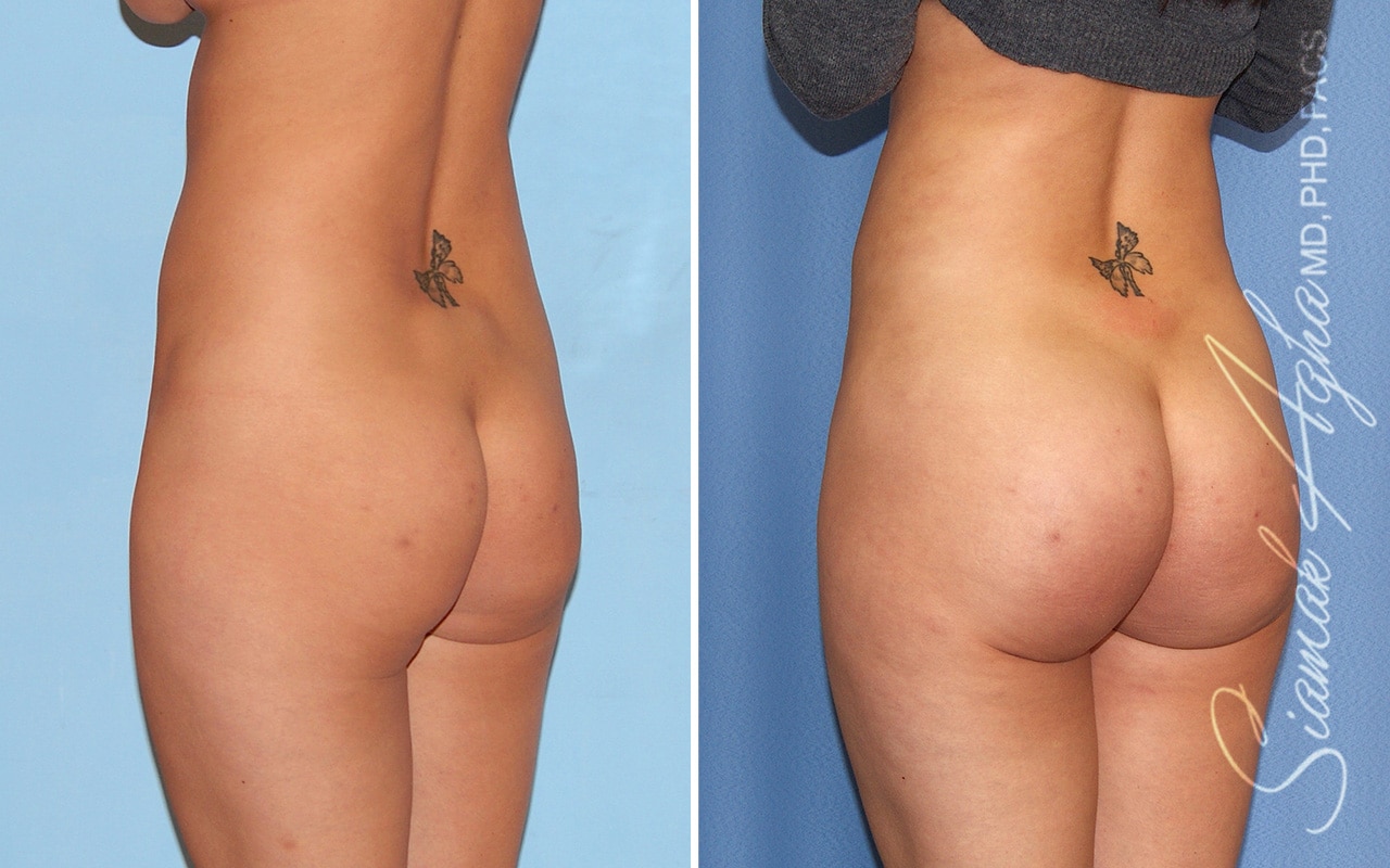 orange county brazilian butt lift patient 60 back left Newport Beach, CA