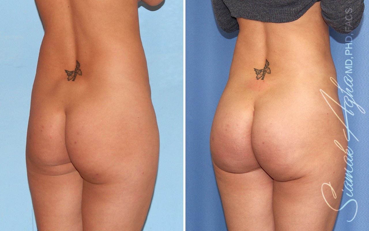 orange county brazilian butt lift patient 60 back right Newport Beach, CA