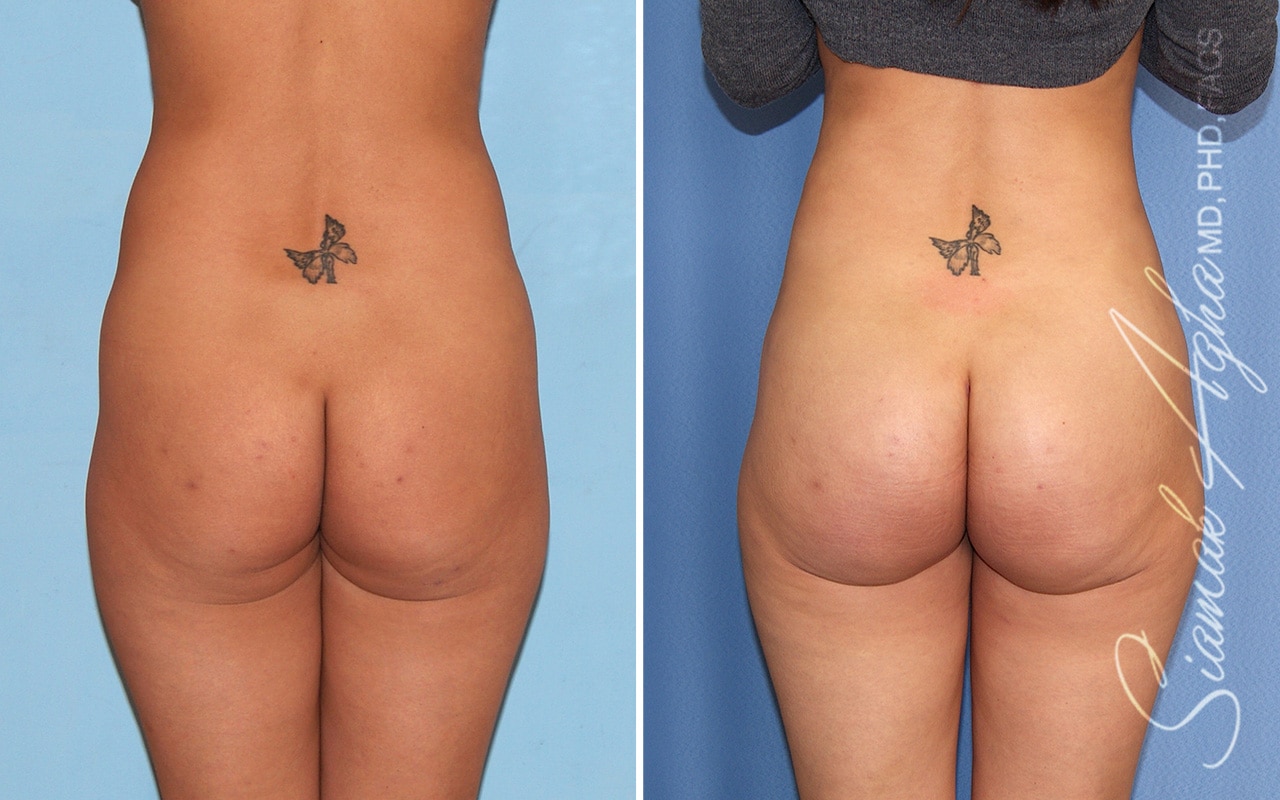 orange county brazilian butt lift patient 60 back Newport Beach, CA