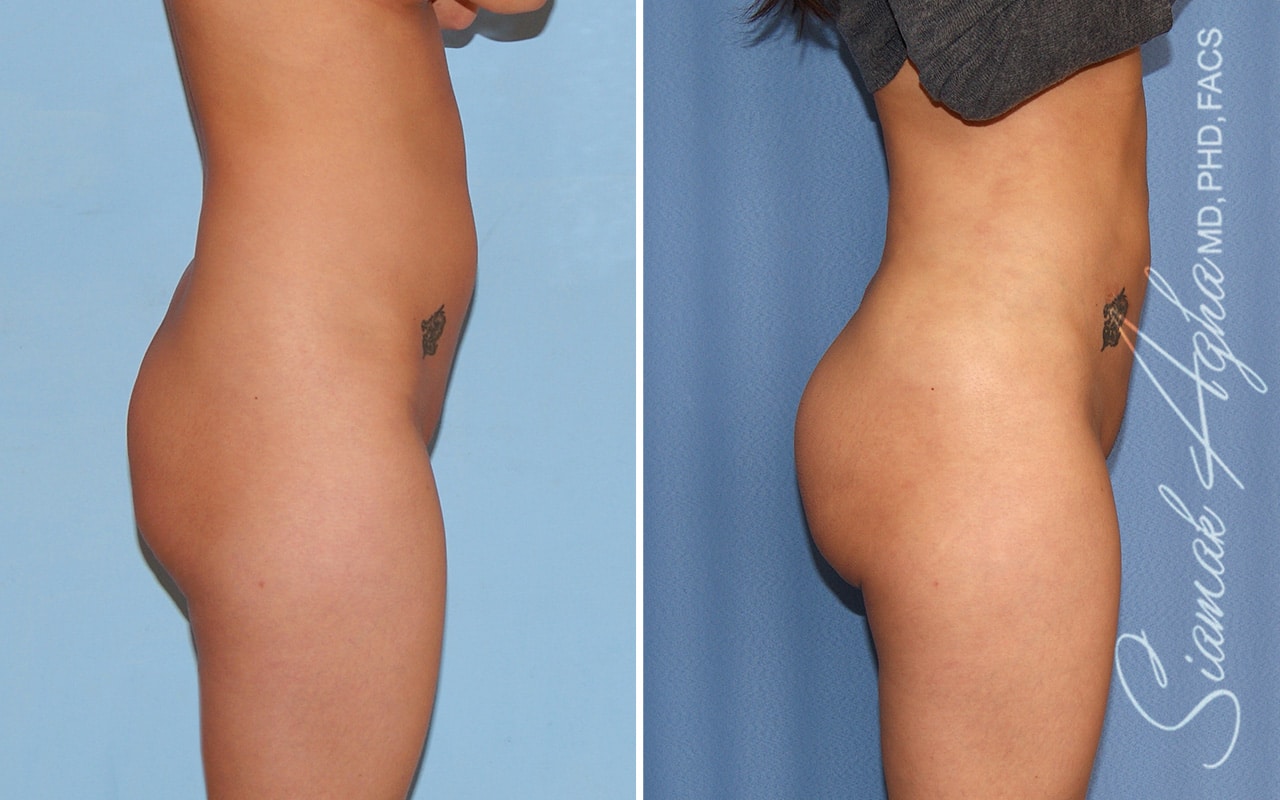 orange county brazilian butt lift patient 60 right Newport Beach, CA