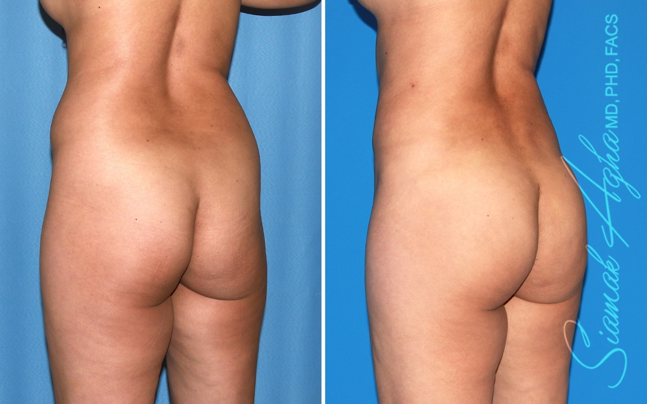 orange county brazilian butt lift patient 61 back left Newport Beach, CA