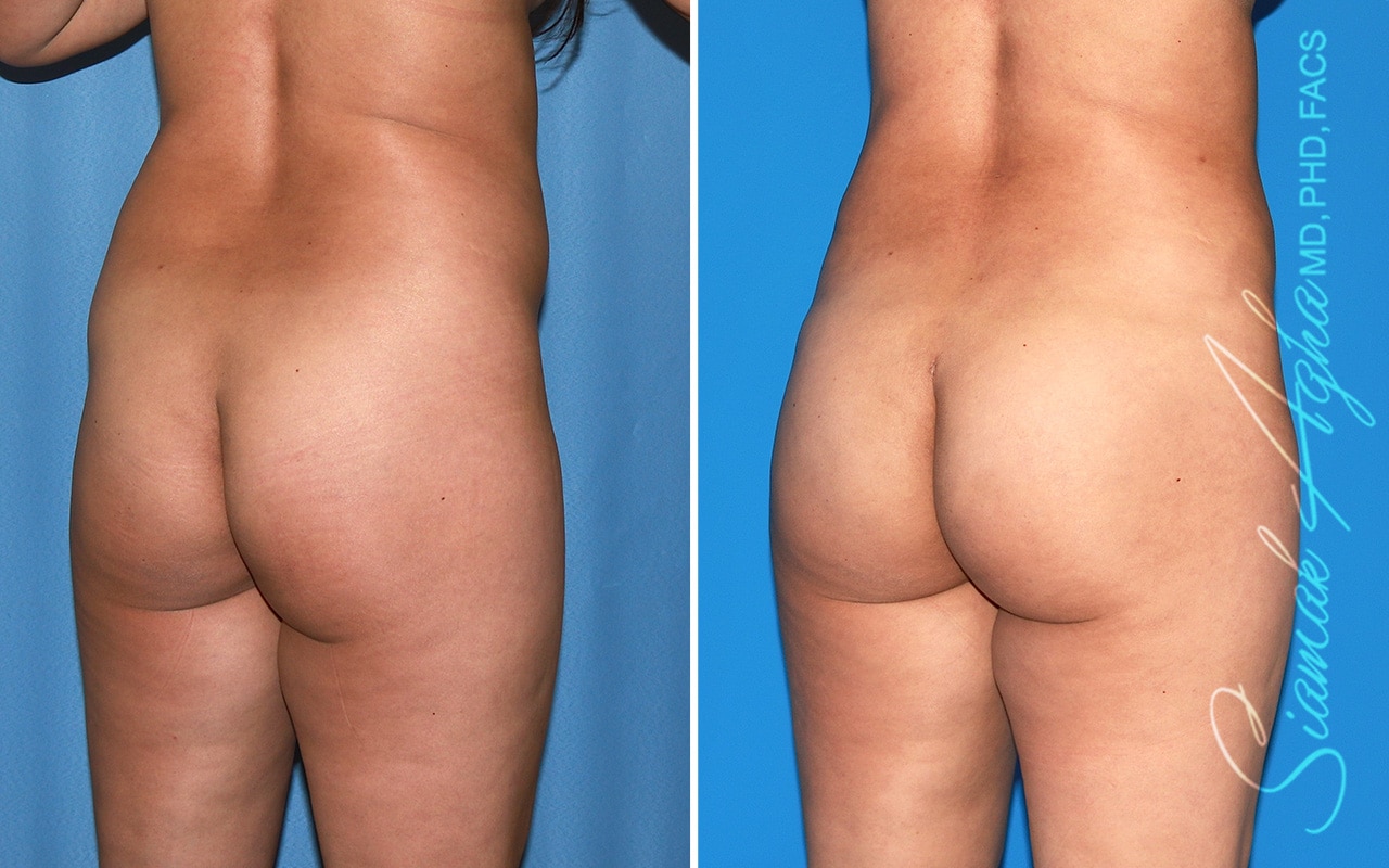 orange county brazilian butt lift patient 61 back right Newport Beach, CA