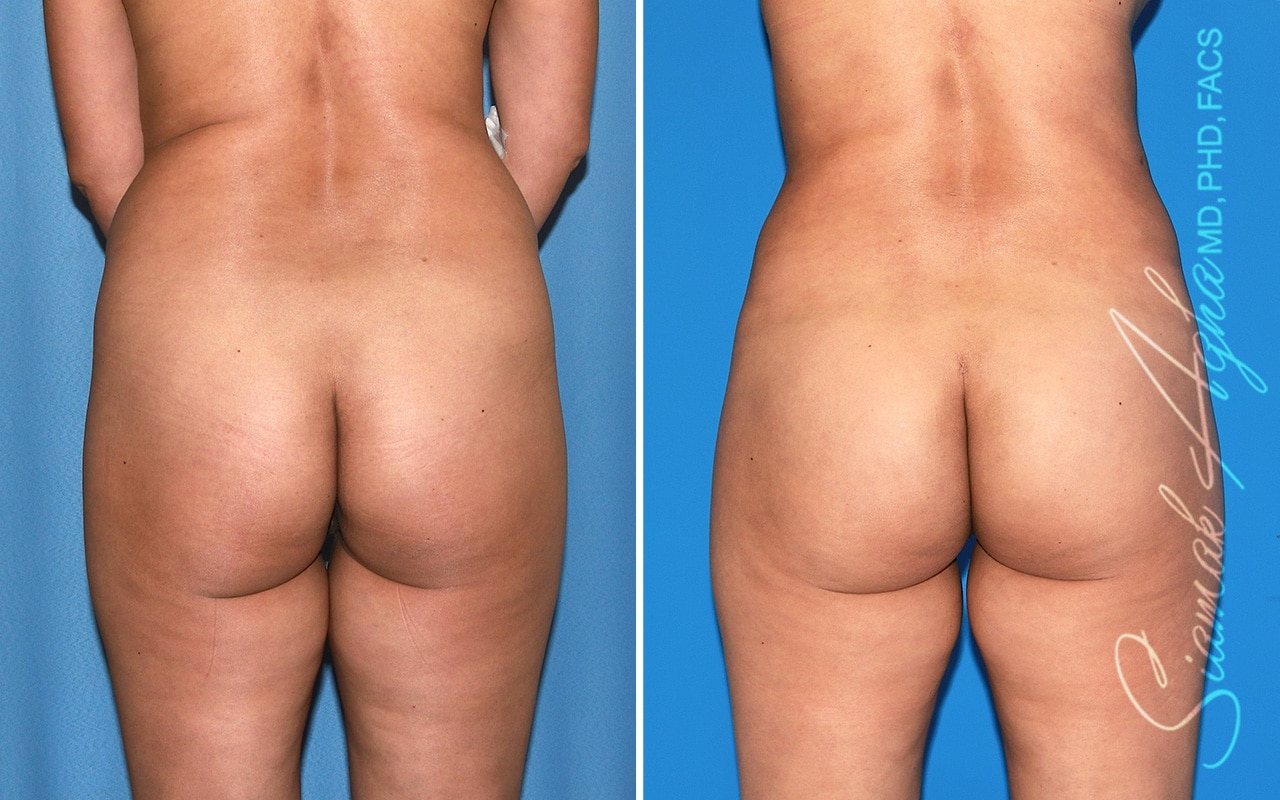 orange county brazilian butt lift patient 61 back Newport Beach, CA