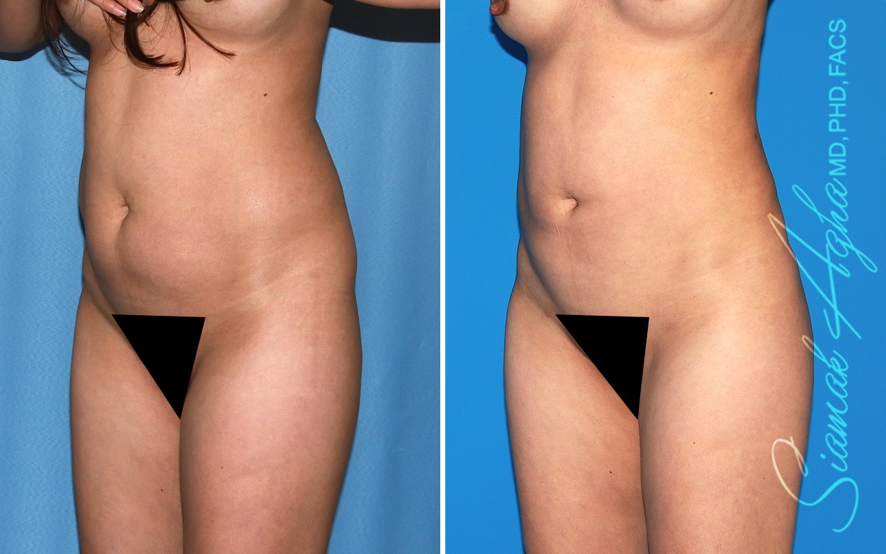 orange county brazilian butt lift patient 61 front left Newport Beach, CA