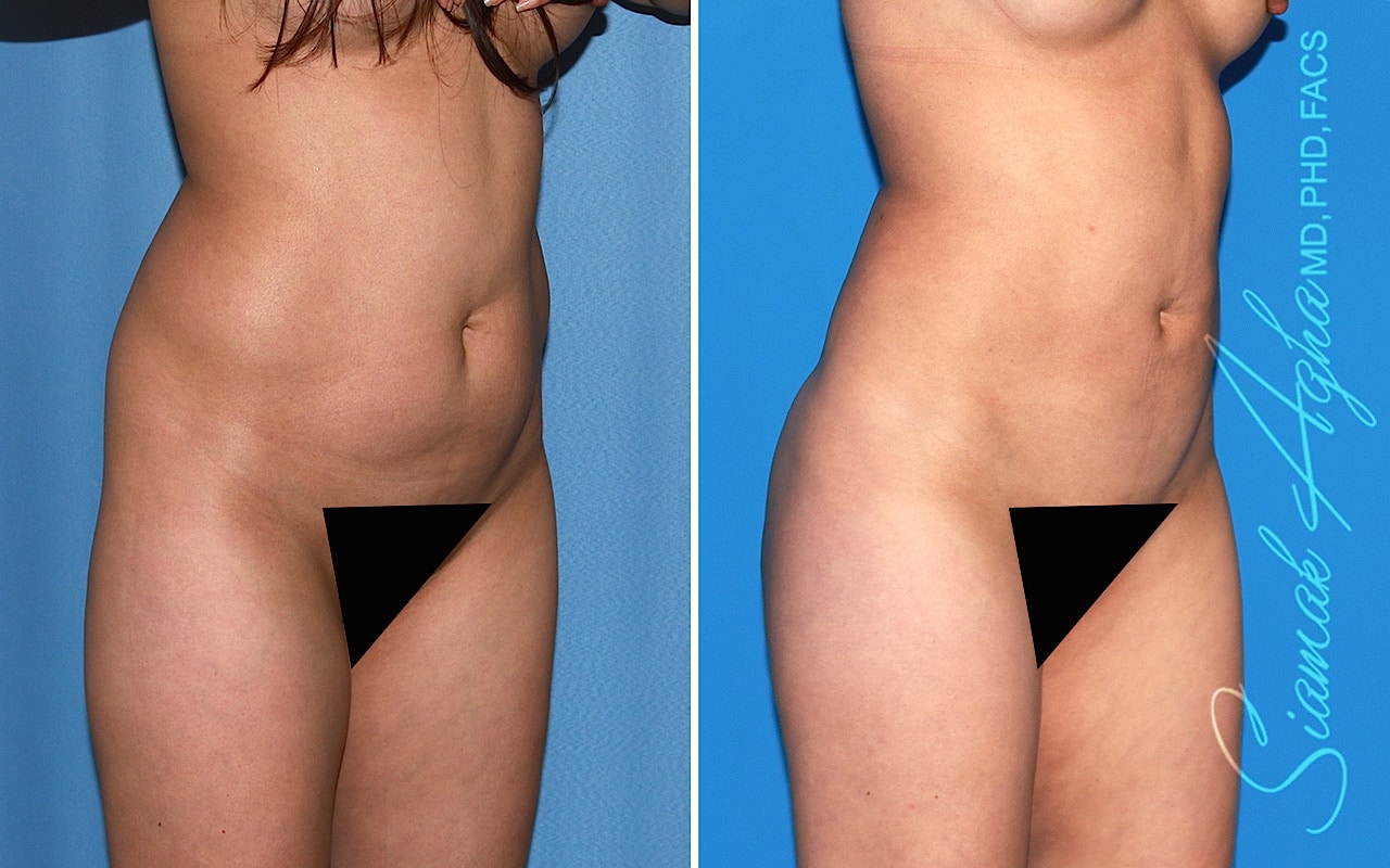 orange county brazilian butt lift patient 61 front right Newport Beach, CA