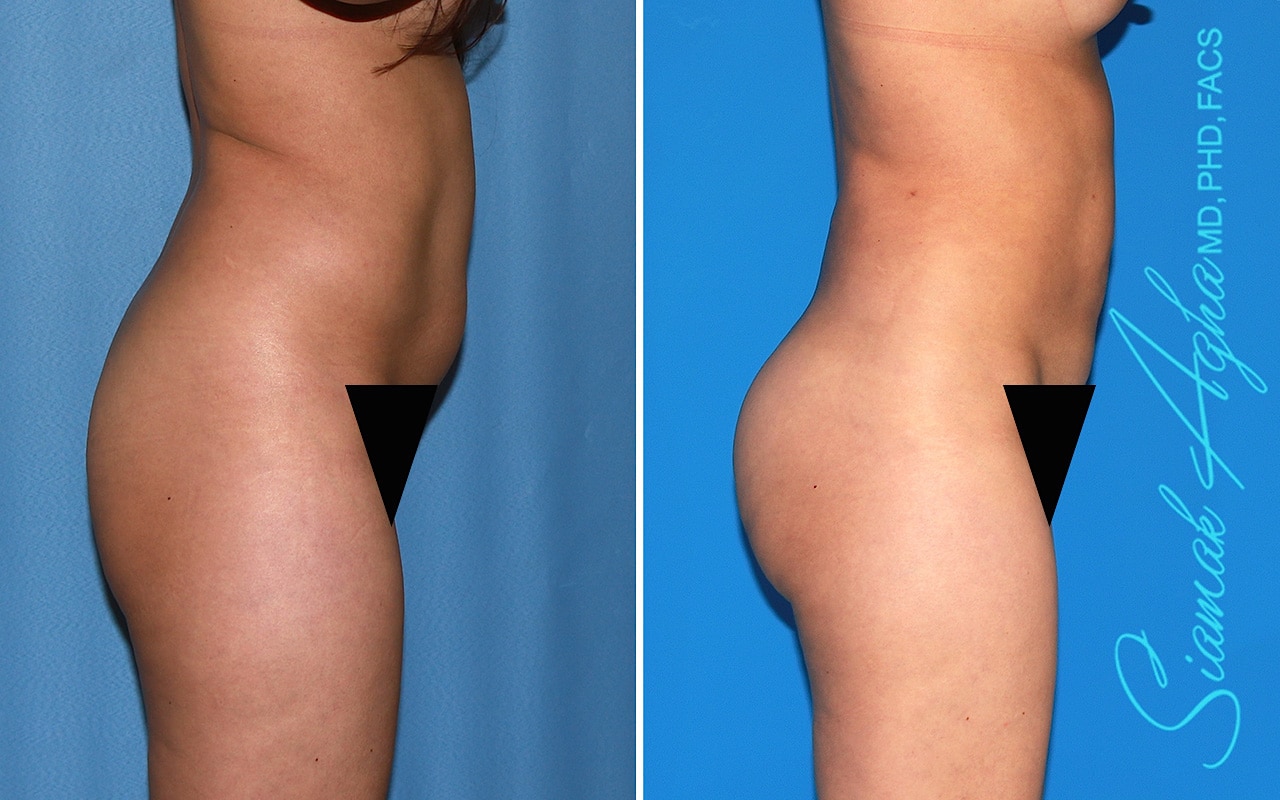 orange county brazilian butt lift patient 61 right Newport Beach, CA