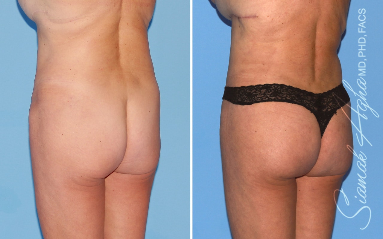 orange county brazilian butt lift patient 62 back left Newport Beach, CA