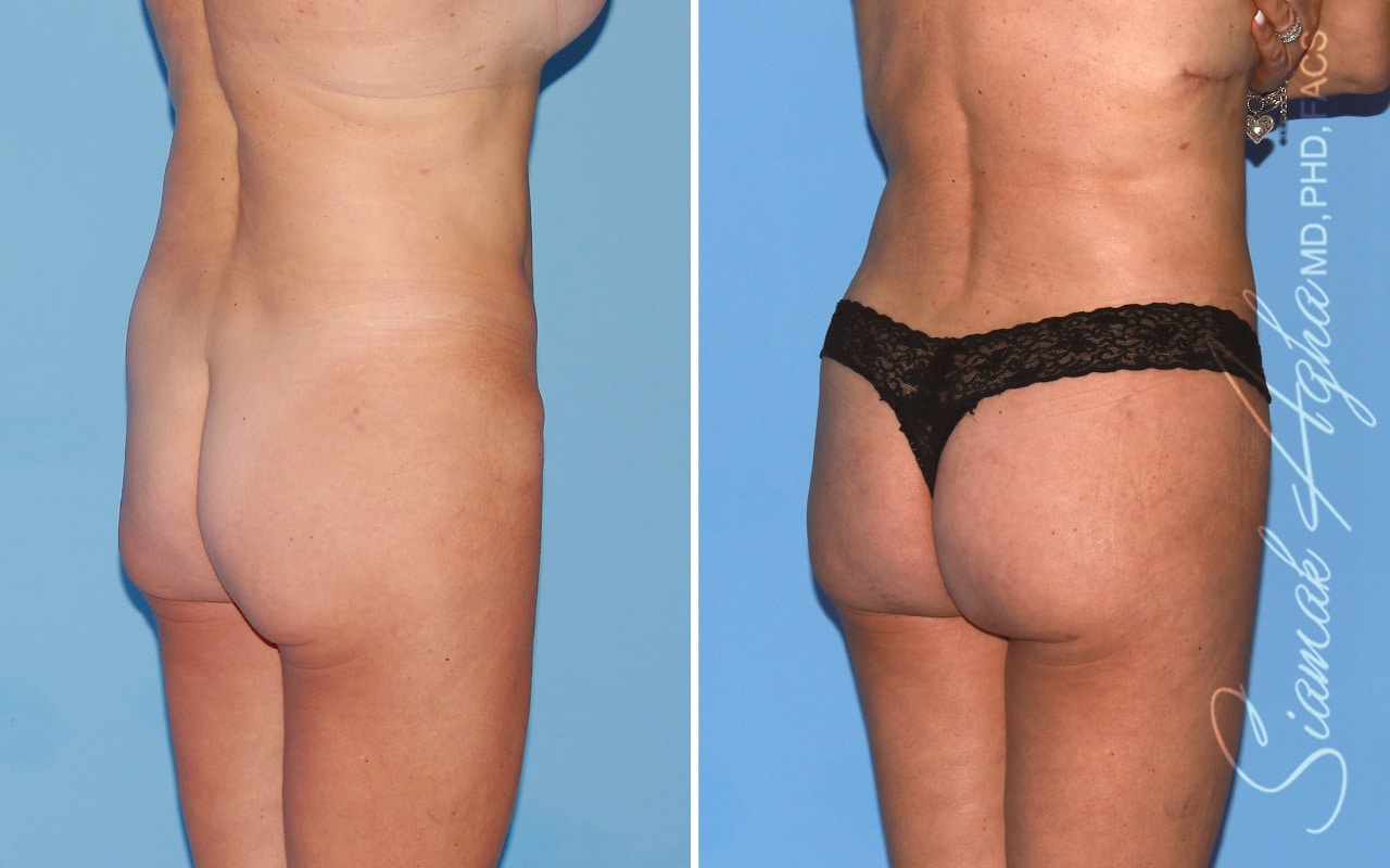 orange county brazilian butt lift patient 62 back right Newport Beach, CA