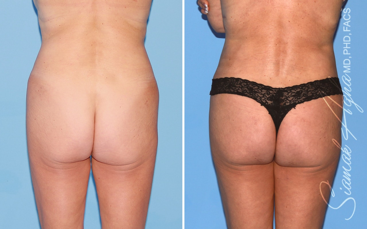 orange county brazilian butt lift patient 62 back Newport Beach, CA