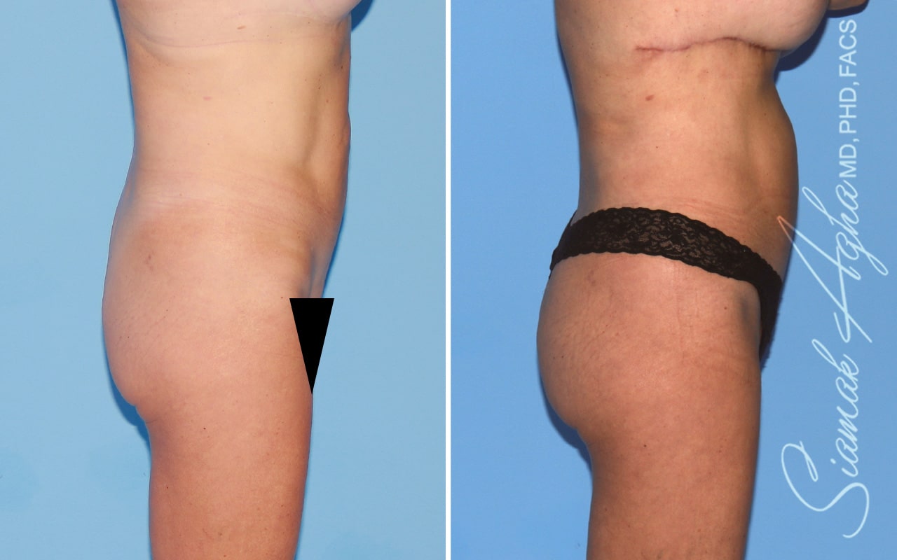 orange county brazilian butt lift patient 62 right Newport Beach, CA