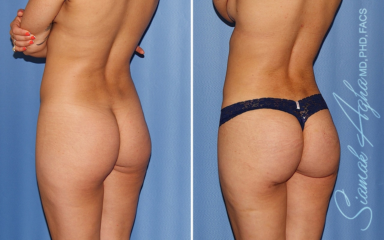 orange county brazilian butt lift patient 63 back left Newport Beach, CA